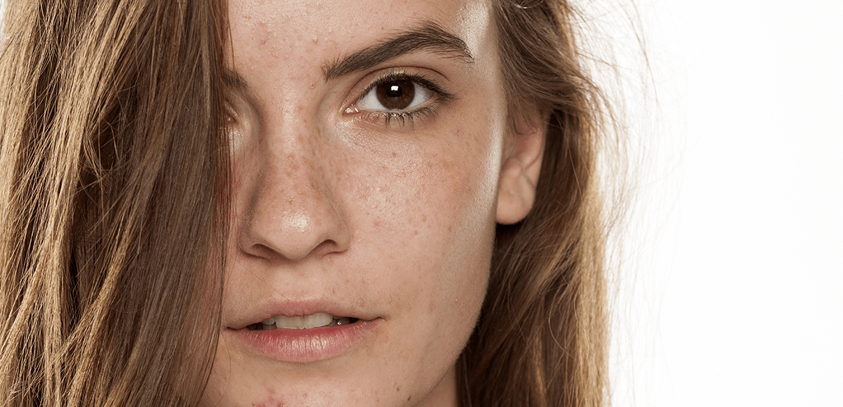 UNDERSTANDING COMBINATION TO OILY SKIN